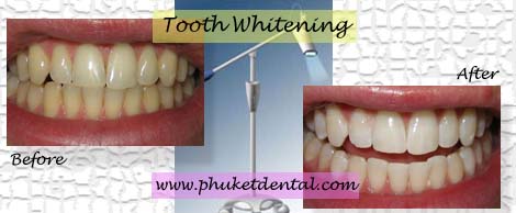 Tooth Whitening:Coldlight,non-LASER,LED,Natural Plus at Phuket Dental Clinic,Thailand